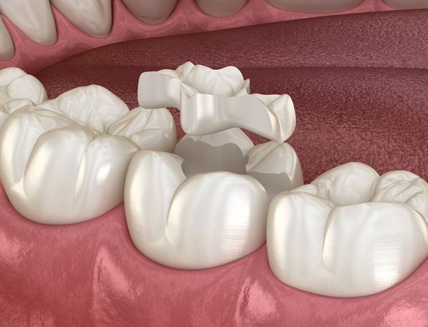 керамические вкладки для зубов